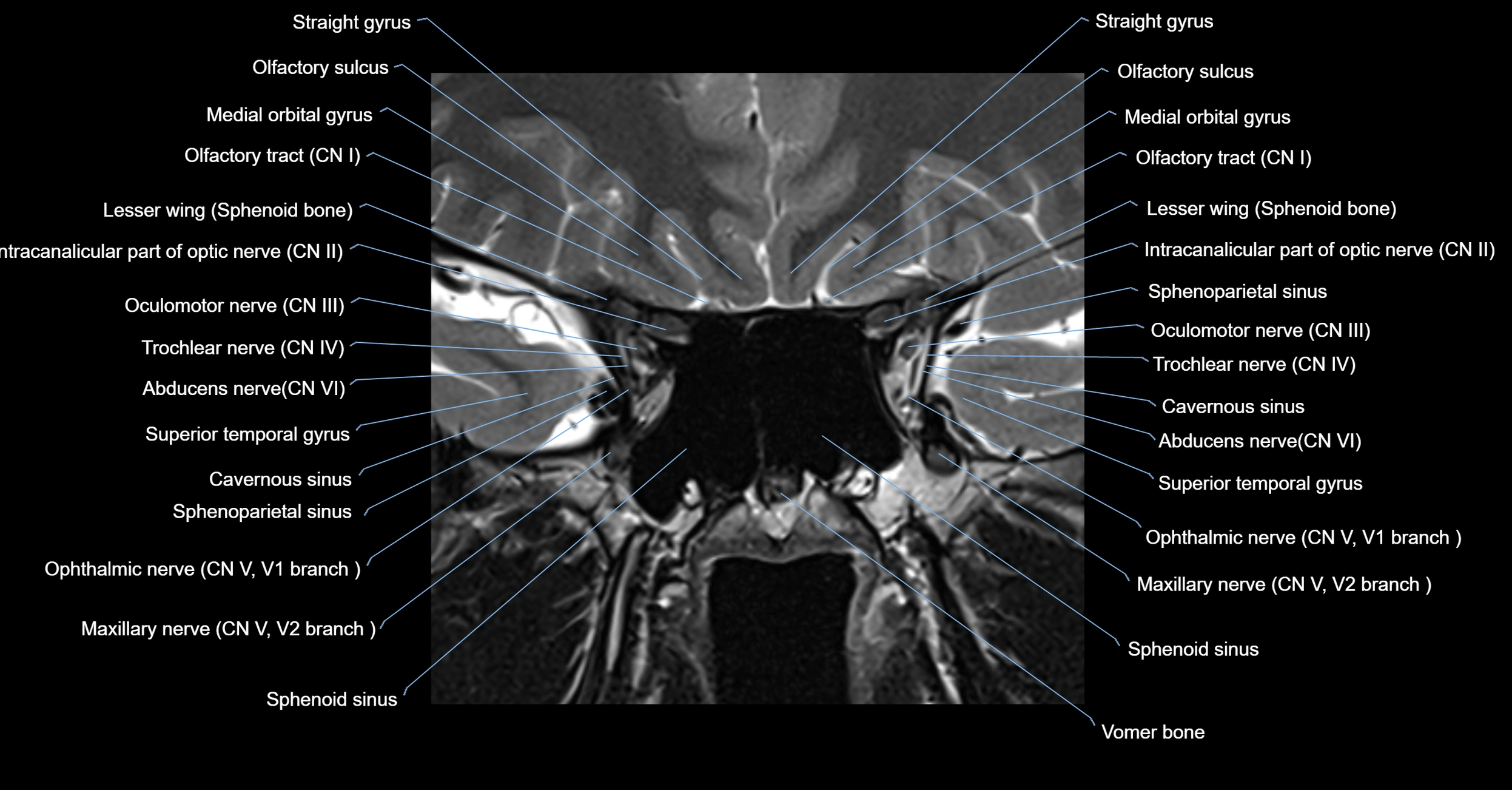 MRI cavernous sinus coronal cross sectional 3T anatomy image-img-00001-00002.webp